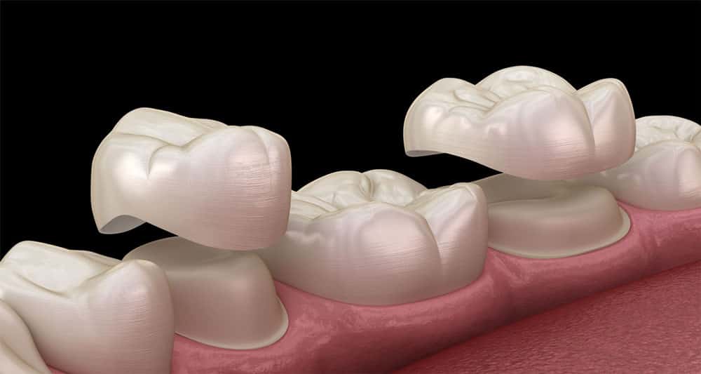 What are porcelain crown? How many types are there? How much does it cost?
