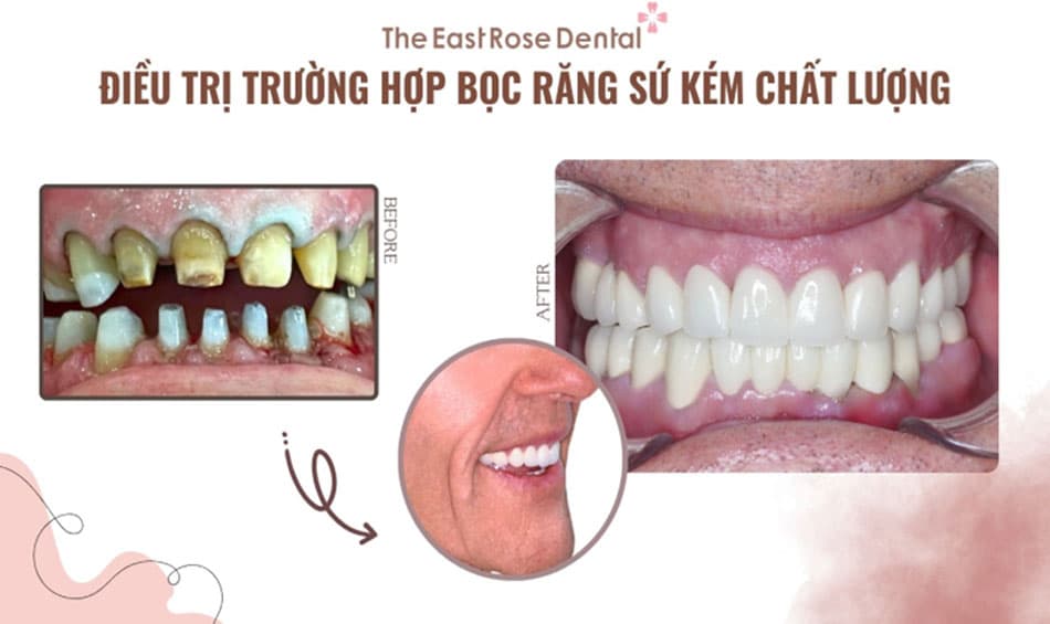 Điều trị trường hợp bọc răng sứ kém chất lượng
