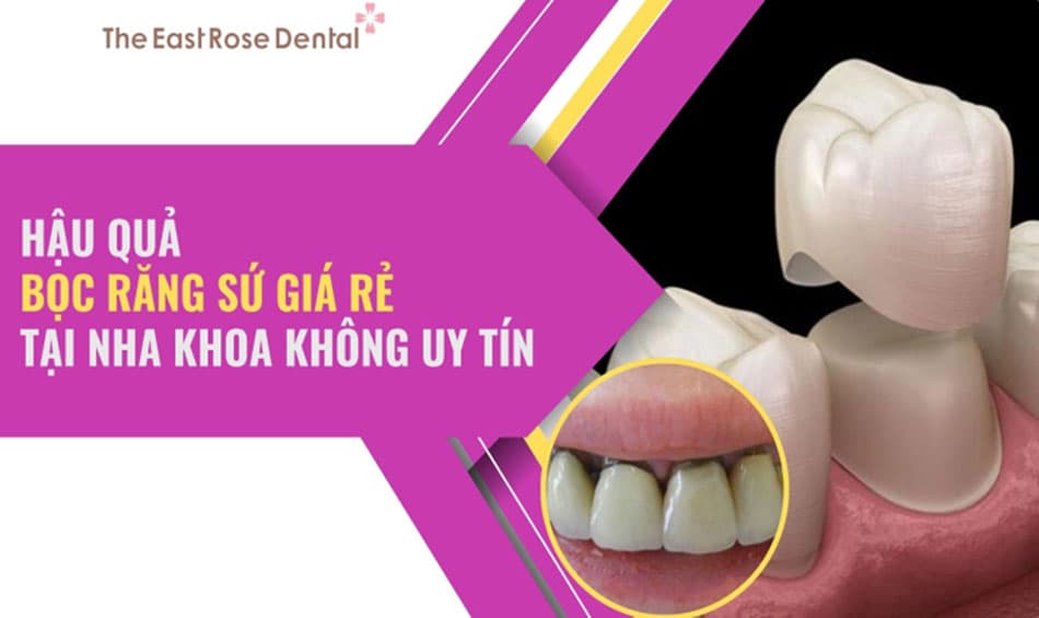 Bọc răng sứ giá rẻ tại nha khoa không uy tín