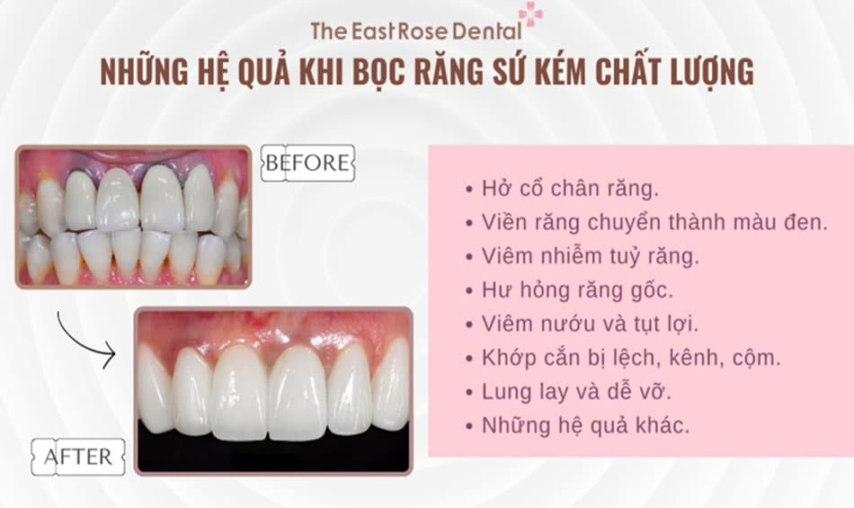 Hệ quả khi bọc răng sứ kém chất lượng tại địa chỉ không uy tín