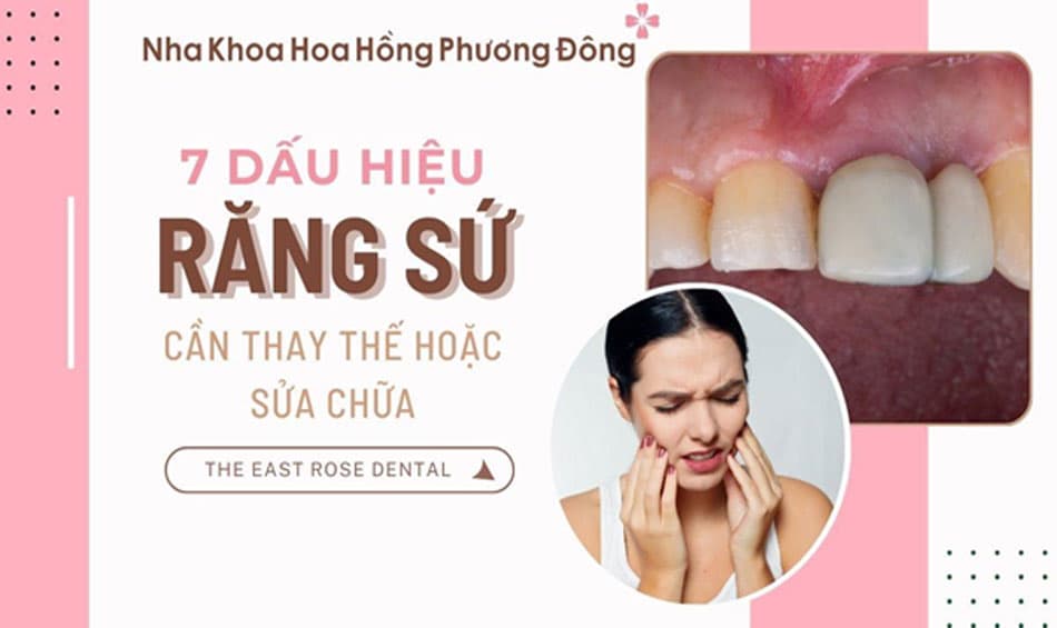 7 Dấu hiệu cảnh báo răng sứ cần thay thế hoặc sửa chữa