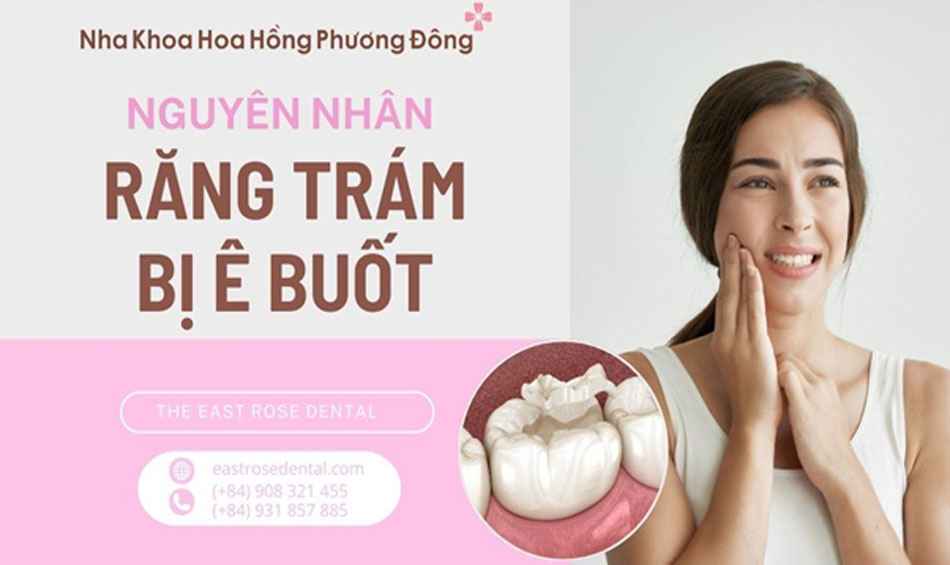 Nguyên nhân khiến răng ê buốt sau khi trám và cách khắc phục hiệu quả