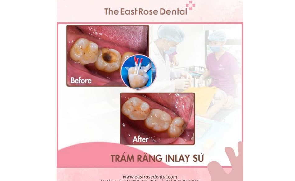 Điều trị vấn đề sâu răng vào tuỷ
