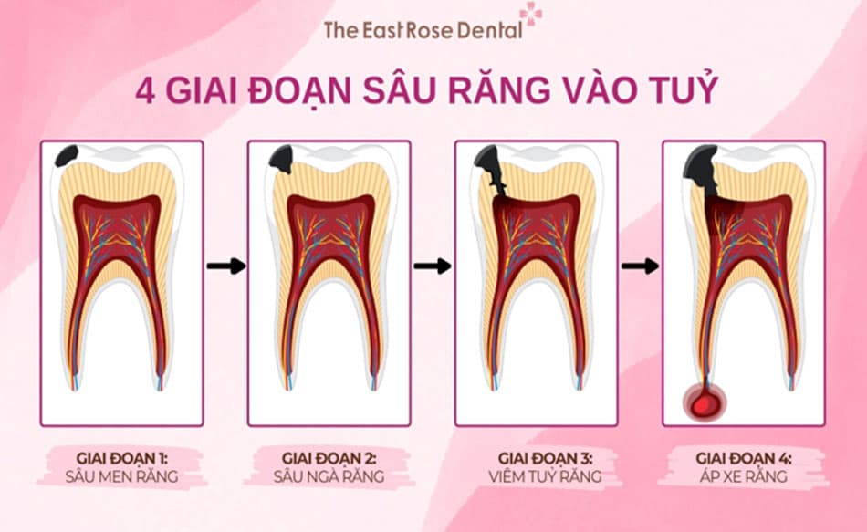 Dấu hiệu sâu răng vào tuỷ theo từng giai đoạn