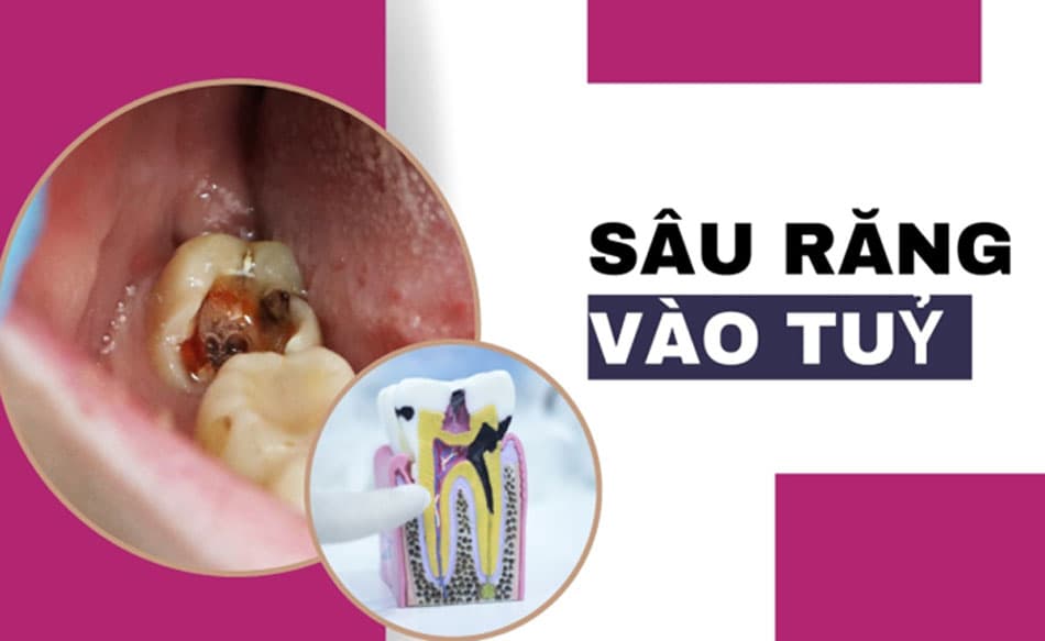 Dấu hiệu sâu răng vào tuỷ và phương pháp điều trị kịp thời