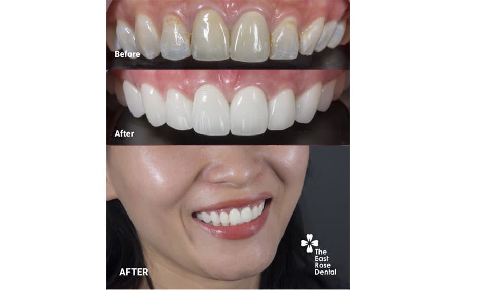 Điều trị tình trạng răng nhiễm fluor bằng phương pháp bọc răng sứ