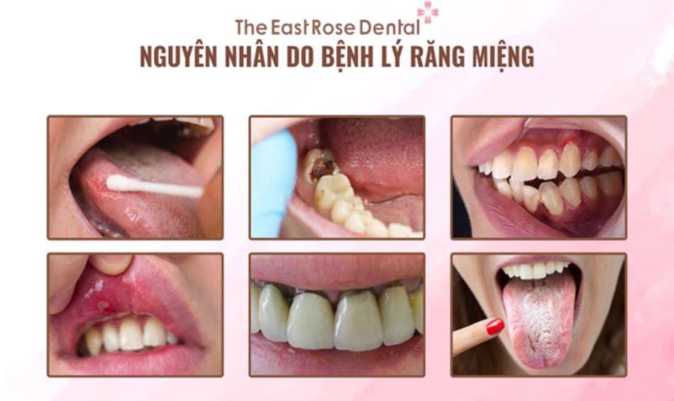 Nguyên nhân do bệnh lý về răng miệng