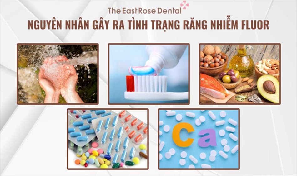 Những nguyên nhân phổ biến gây nên tình trạng răng nhiễm fluor