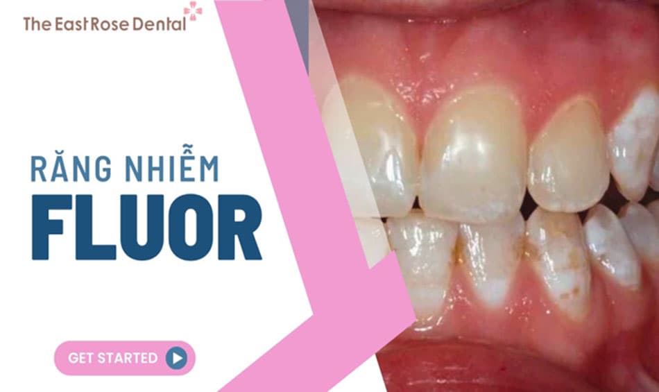 Răng nhiễm fluor: Nguyên nhân và hướng điều trị hiệu quả