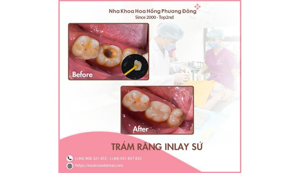 Điều trị viêm tủy răng tại Nha Khoa Hoa Hồng Phương Đông