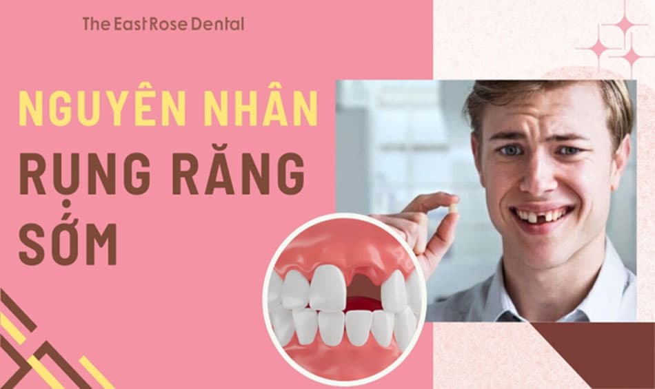 Nguyên nhân rụng răng sớm và những hệ luỵ đáng báo động