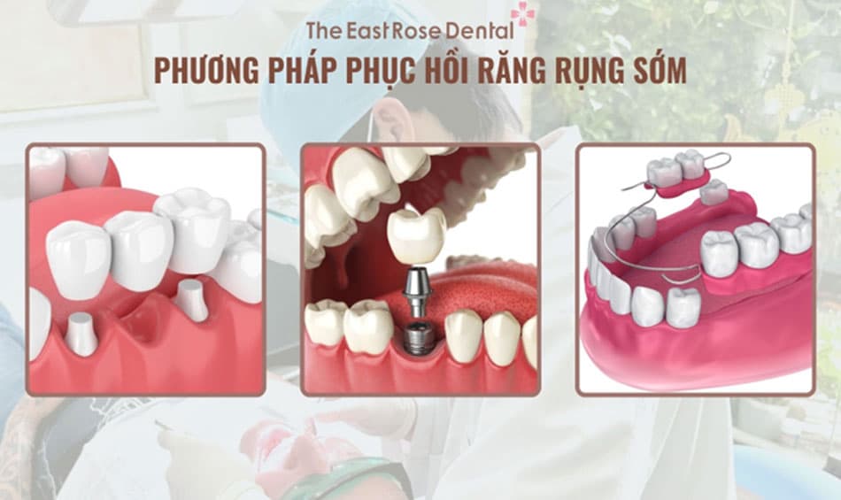 Phương pháp phục hồi tình trạng răng rụng sớm