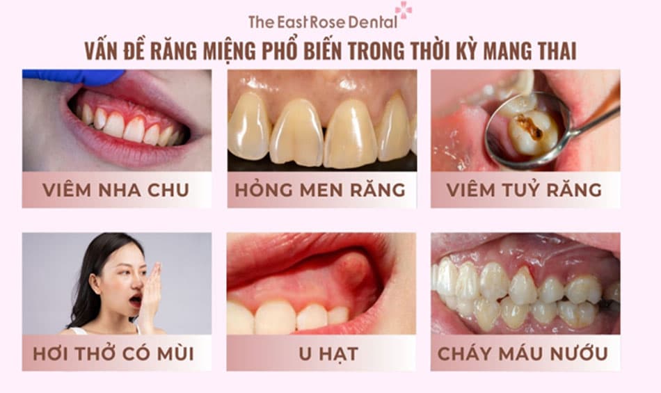 Vấn đề răng miệng phổ biến trong thời kỳ mang thai