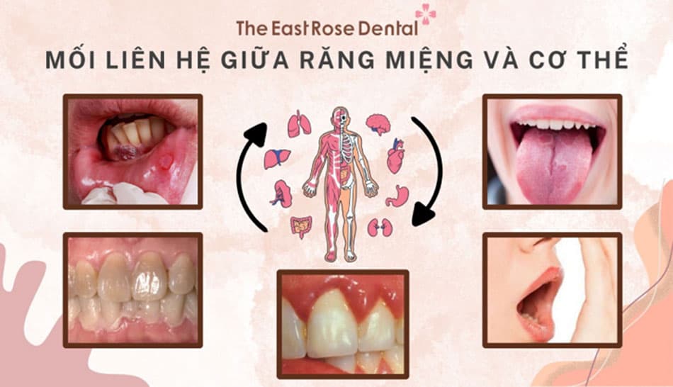 Mối liên hệ giữa tình trạng răng miệng và sức khỏe cơ thể