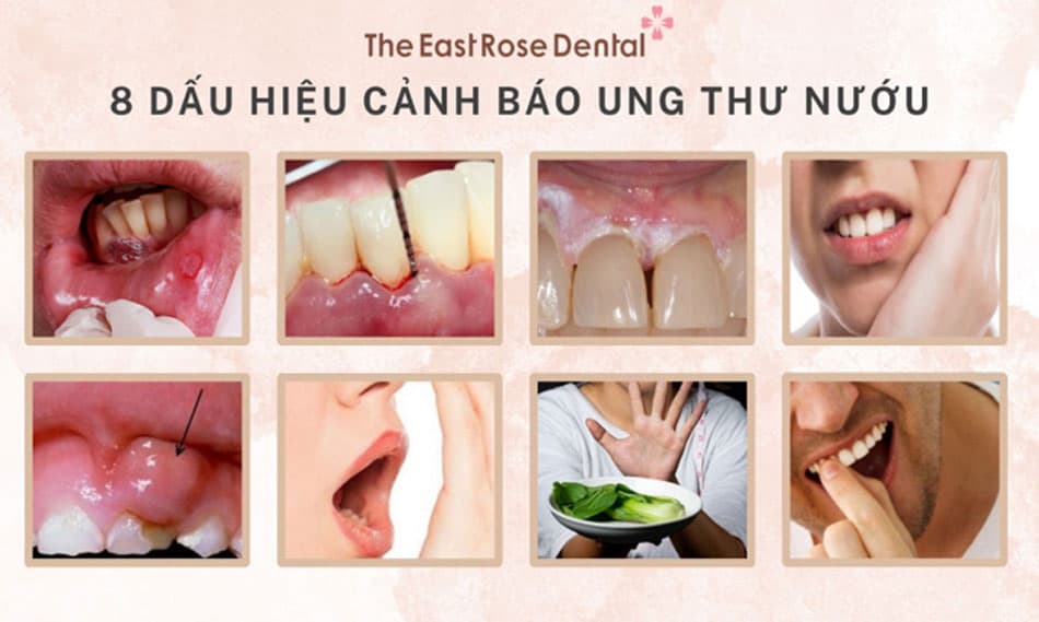 Dấu hiệu cảnh báo ung thư nướu răng sớm