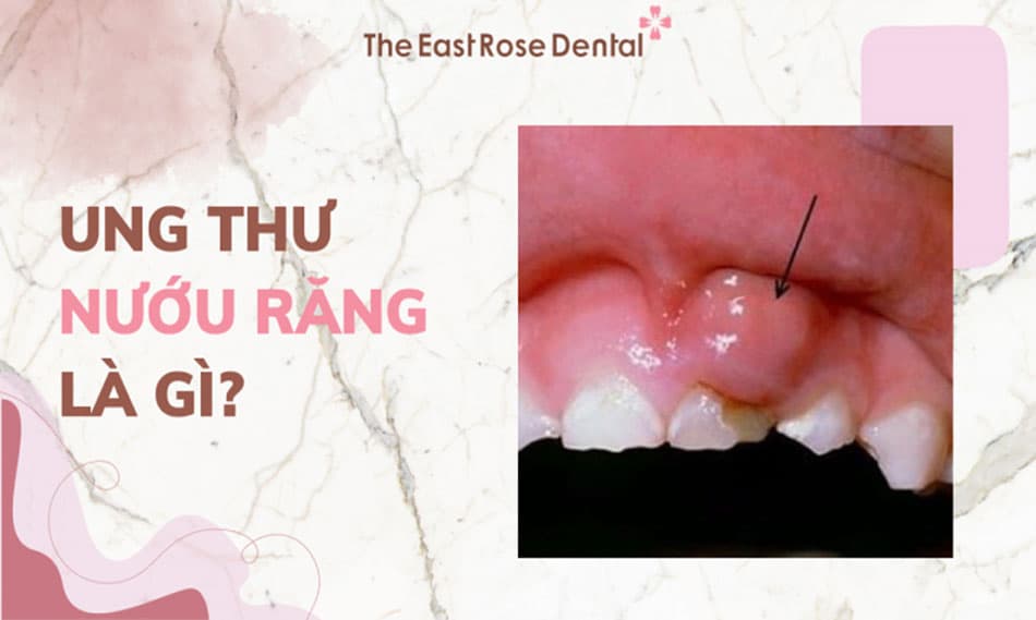 8 triệu chứng sớm của ung thư nướu răng và phương pháp điều trị
