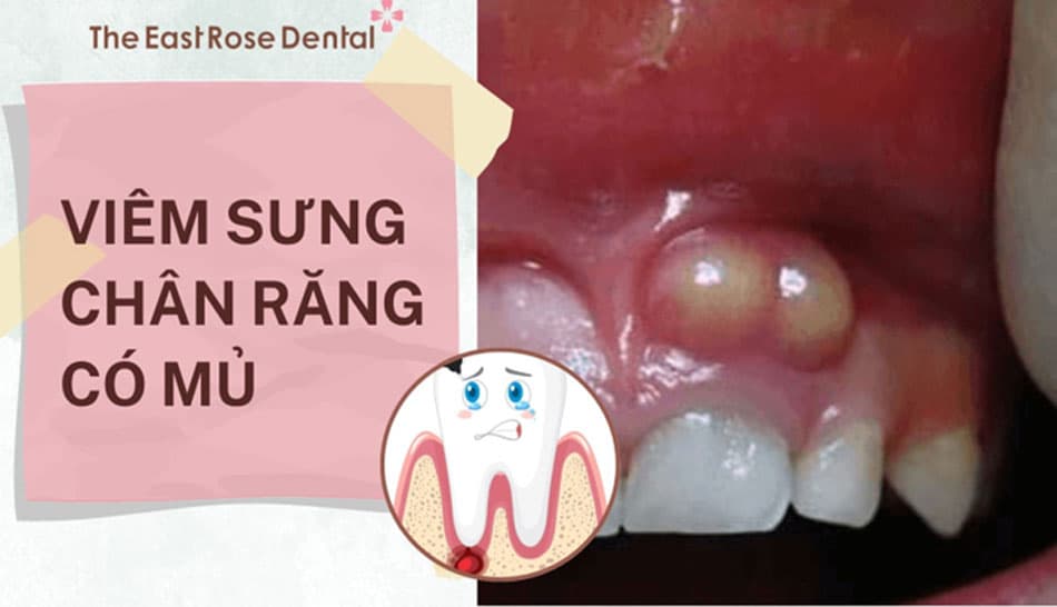 Nguyên nhân sưng chân răng có mủ và cách điều trị tại nhà