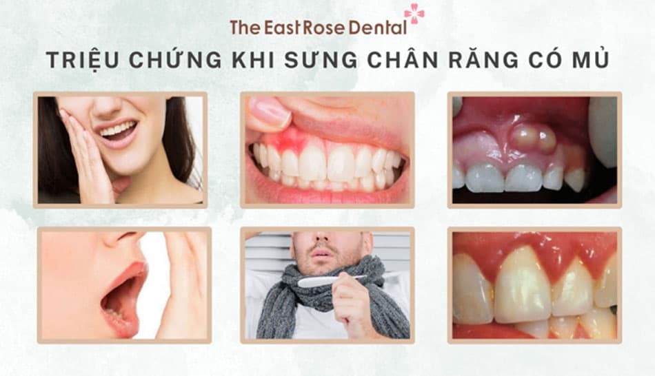 Các Triệu chứng khi bị sưng chân răng có mủ