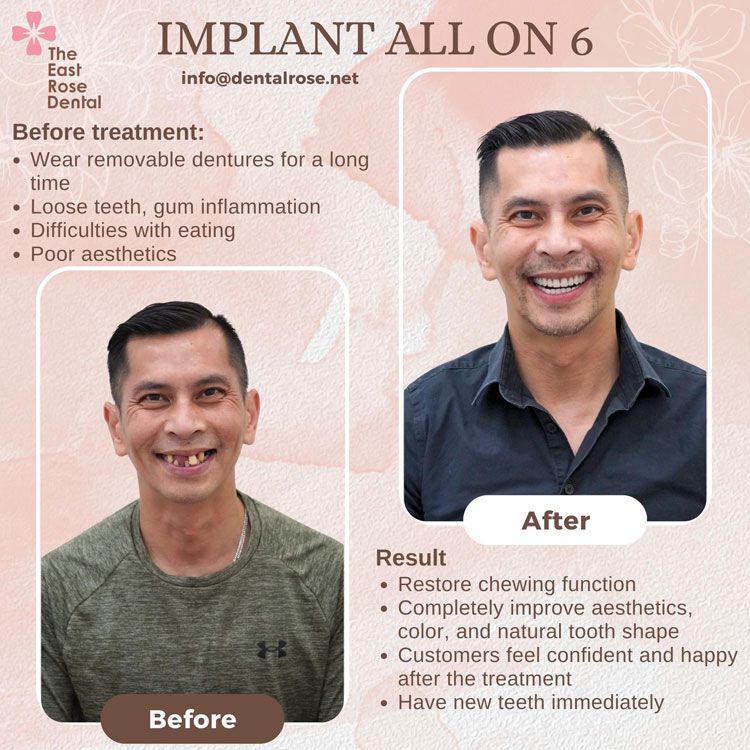 Implant all on 6