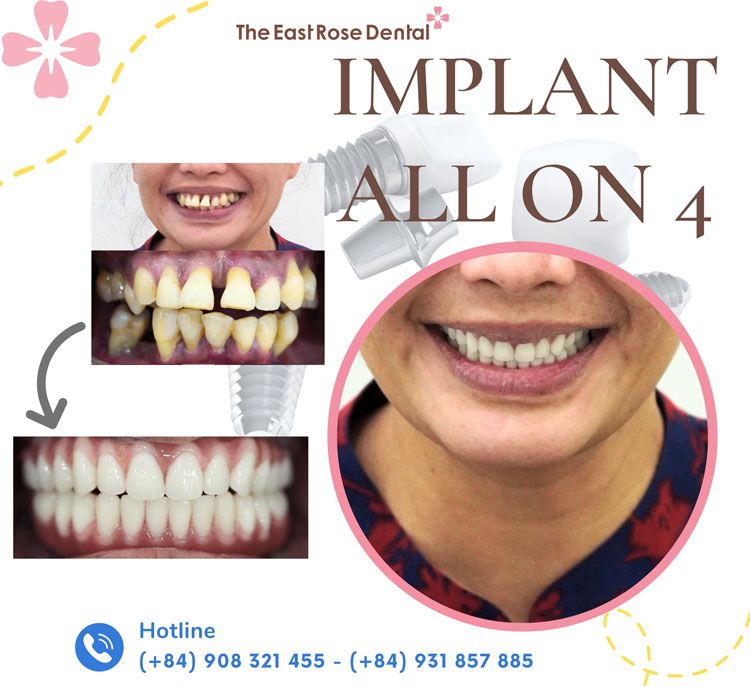 Case implant all on 4 được thực hiện tại Nha Khoa Hoa hồng Phương Đông