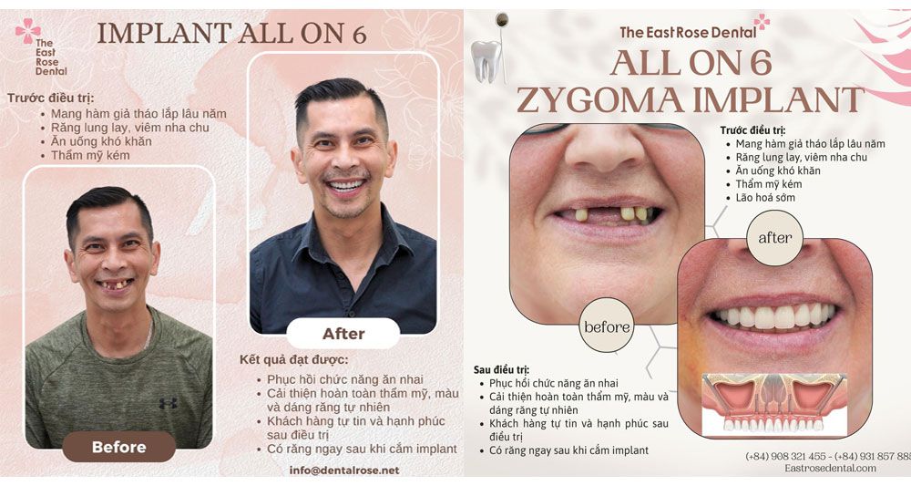2 Case implant all on 6 được thực hiện tại Nha Khhoa Hoa Hồng Phương Đông