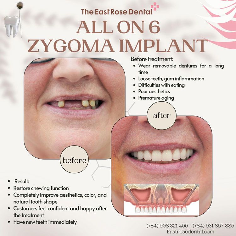 implant all on 6 zygoma