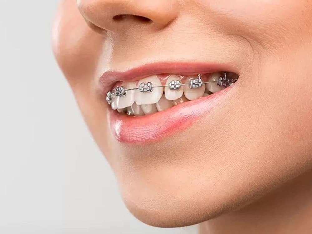 Is it okay to swallow braces? How should it be handled?
