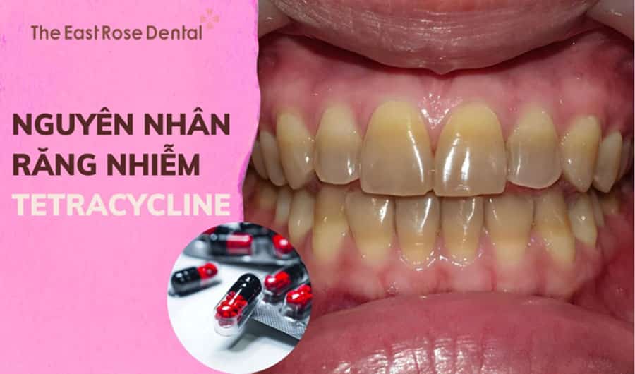 Tìm hiểu răng nhiễm Tetracycline và các phương pháp điều trị hiệu quả