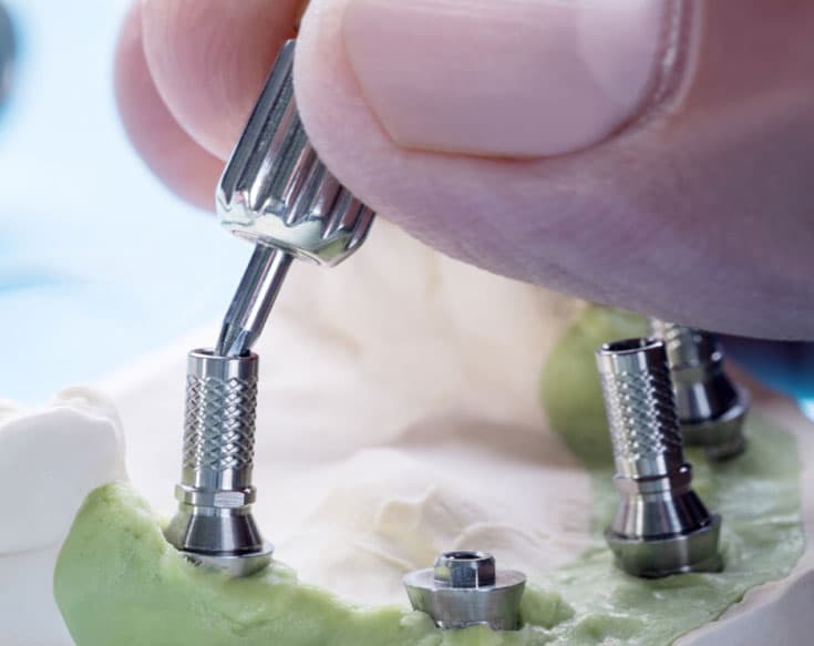Advantages of Customized Abutment