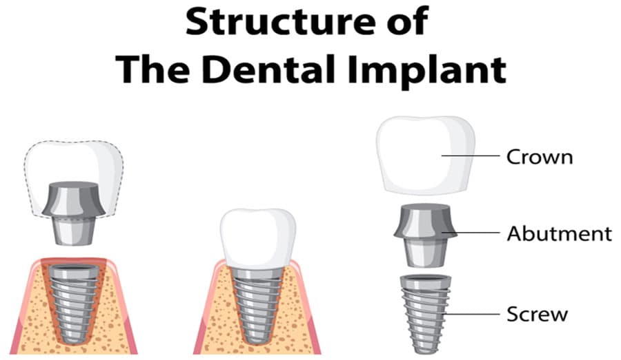 Tìm hiểu vai trò của Abutment Implant