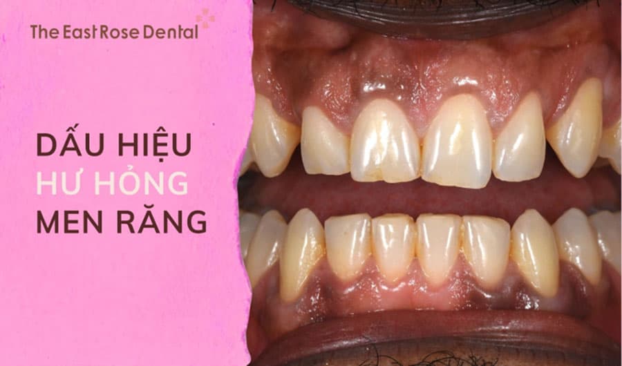 4 Dấu hiệu men răng hỏng và cách khắc phục hiệu quả