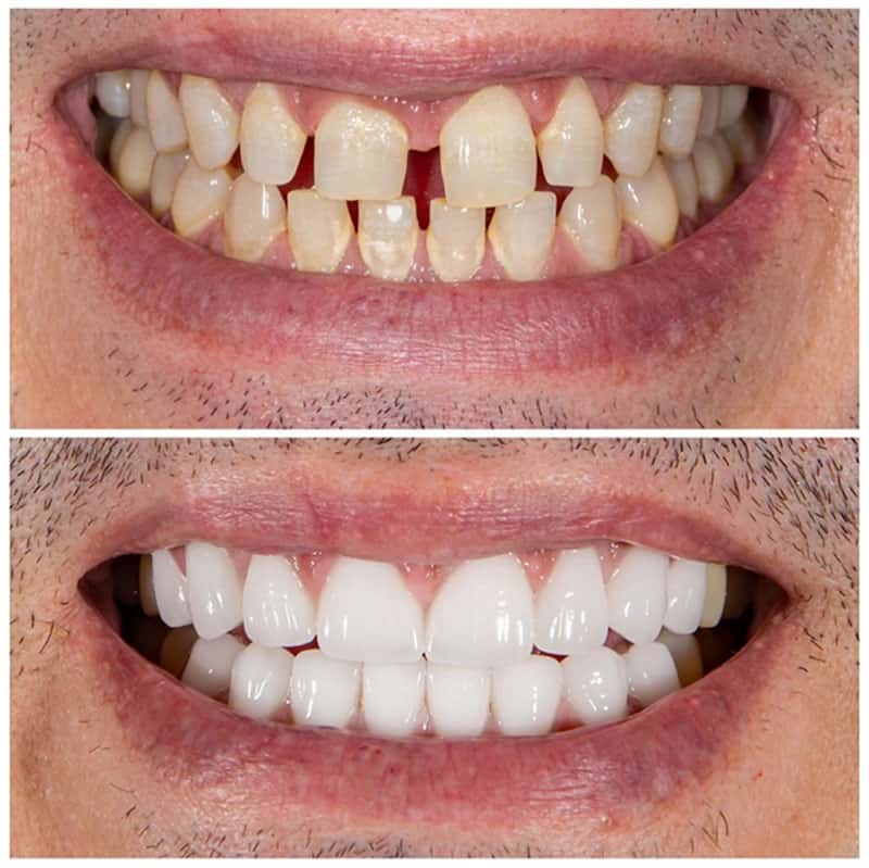 Khắc phục tình trạng hỏng men răng bằng cách bọc răng sứ