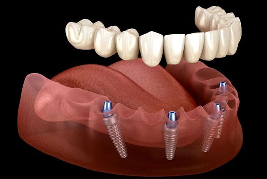 All On 4 Full Jaws Treatment Process At The East Rose Dental Clinic