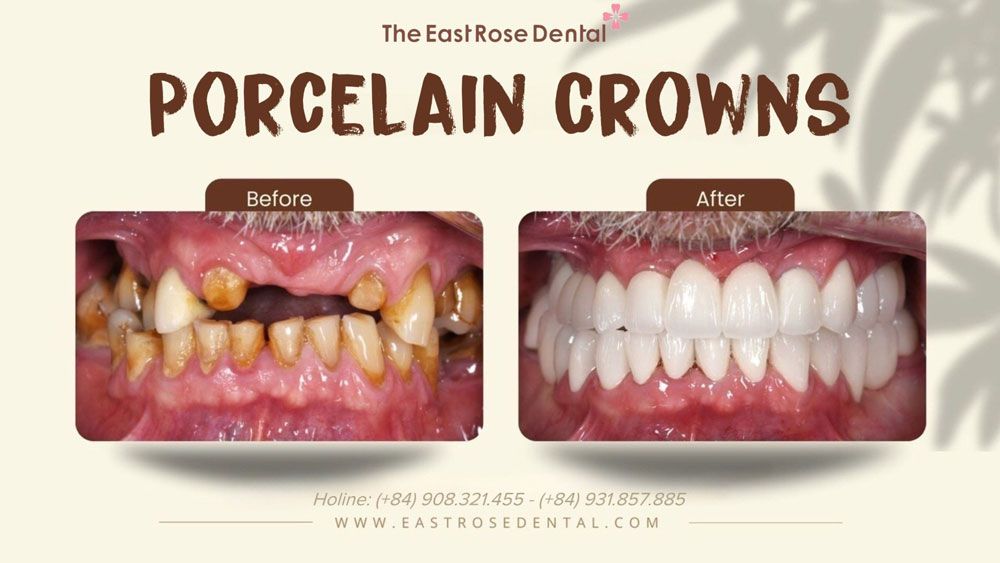 Case Porcelain Crown at The East Rose Dental Clinic