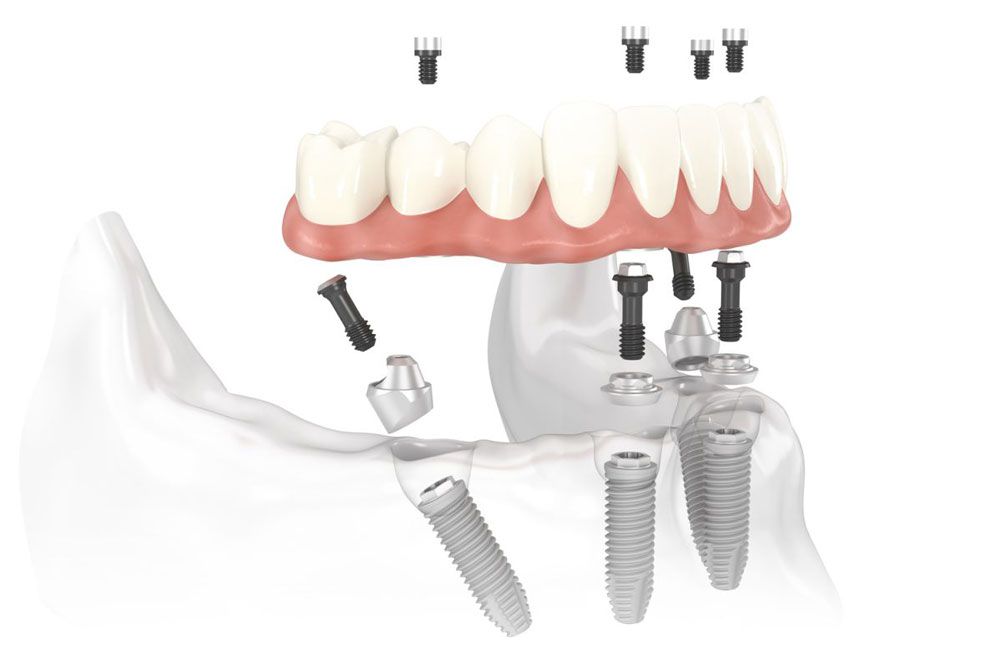 Phương pháp cấy Implant All on 4