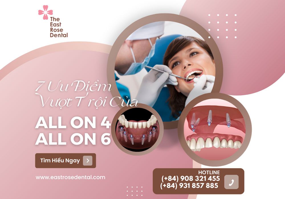 7 Ưu điểm vượt trội của ALL ON 4 / ALL ON 6