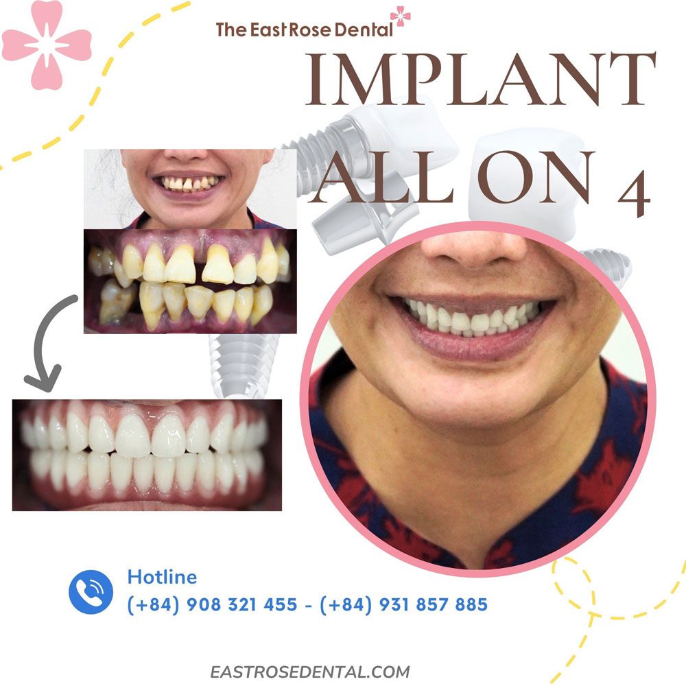 case implant all on 4 
