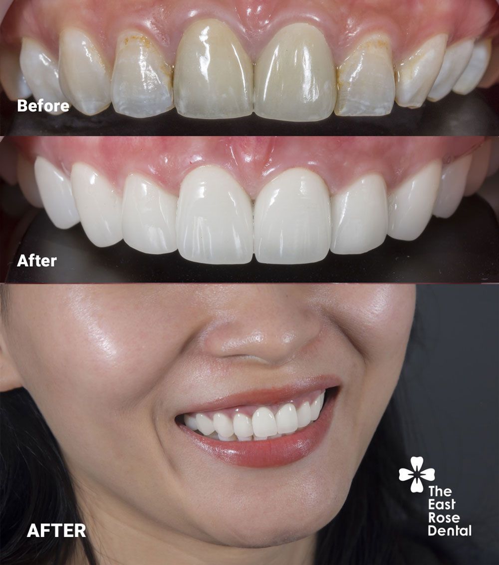 Case porcelain at The East Rose Dental Clinic at HCM