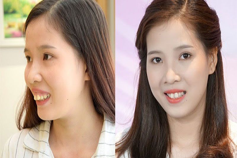 A overbite surgery takes about 2-3 hours