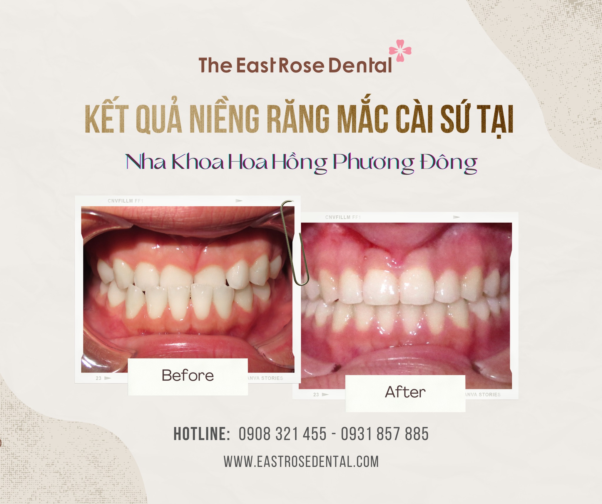 niềng