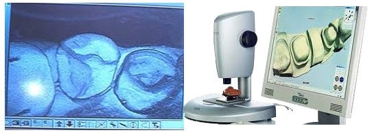 tạo răng sứ bằng cách scan mẫu hàm