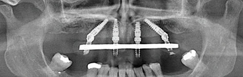 All On 4 Plus treatment with sinus grafting and insertion