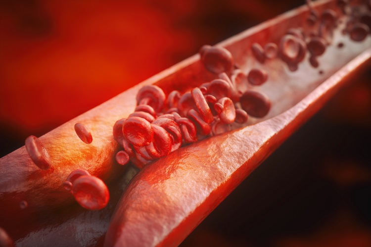 Atherosclerosis 