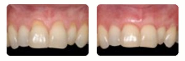 Gum Graft Surgery case 2