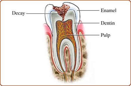 dental sealants