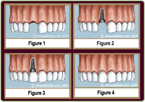 Dental implant procedure