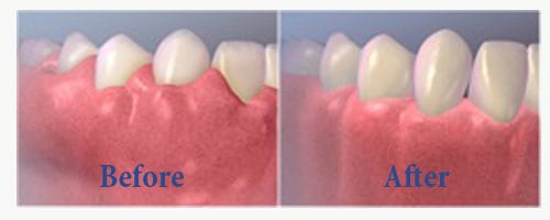 gingivectomy