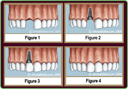 how do i get dental implants