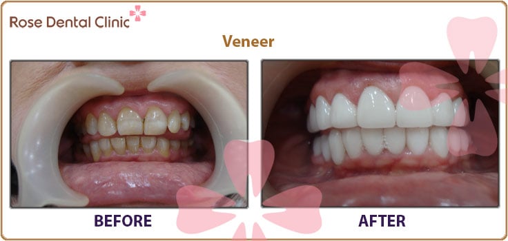 veneers before after