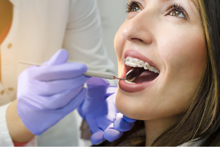 How long will you have to wear braces?